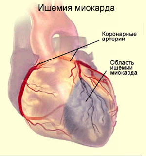 упражнения чтобы похудели икры