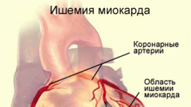 КАК РАСПОЗНАТЬ ИНФАРКТ МИОКАРДА