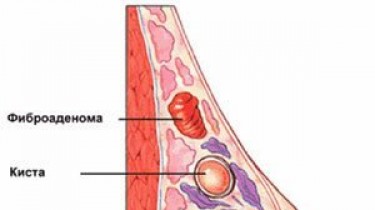 Фиброаденому лучше удалить
