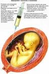 Европарламентарии призывают Литву не запрещать аборты