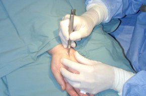 В Германии проведена уникальная операция по пересадке рук