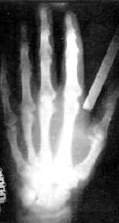 Мир узнал о рентгеновских лучах и Рентгене, гениальном ученом, которого выгнали из школы